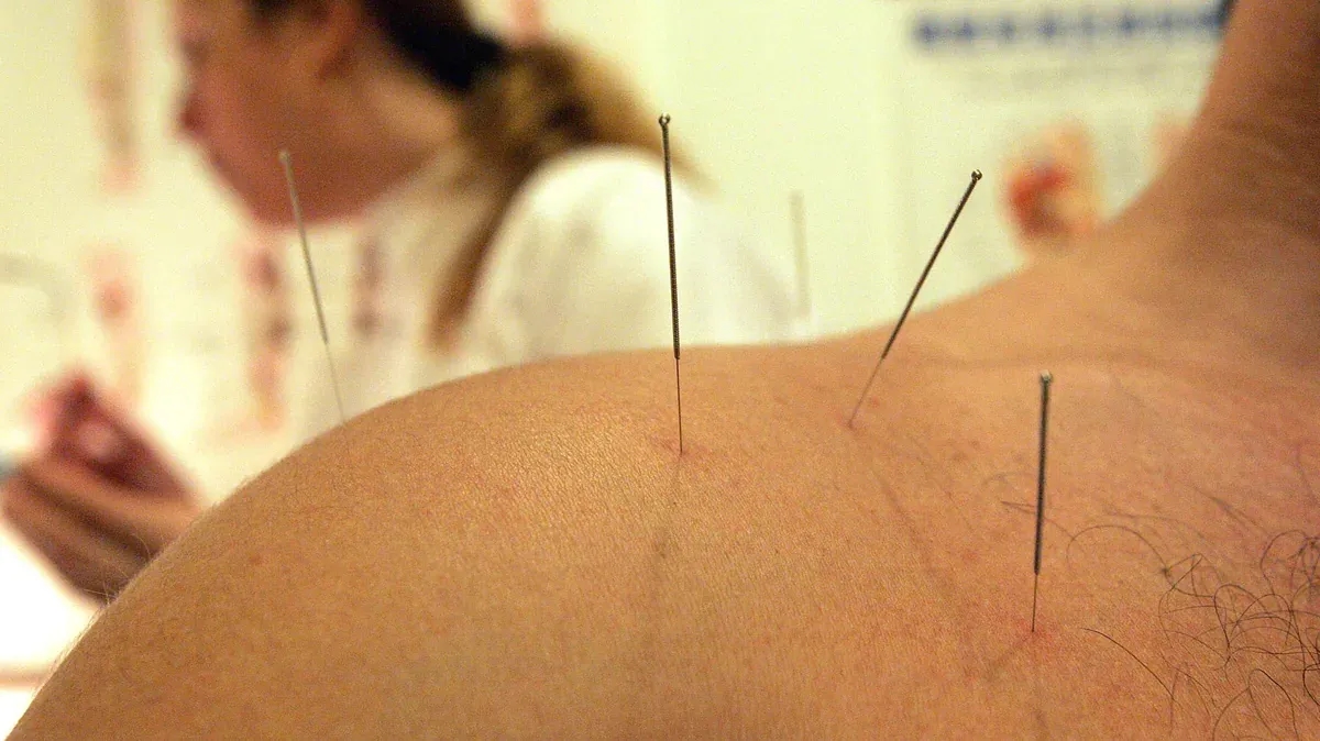 Acupuncture